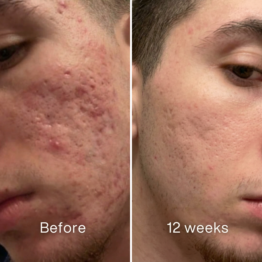 Face Serum Niacinamide 10% + Zinc 1%, Smoothing Serum for Blemish-Prone Skin