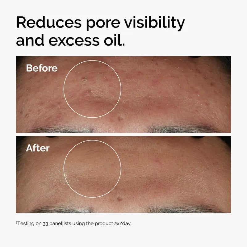 Face Serum Niacinamide 10% + Zinc 1%, Smoothing Serum for Blemish-Prone Skin