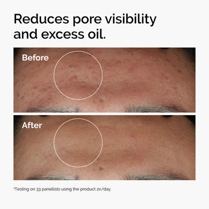 Face Serum Niacinamide 10% + Zinc 1%, Smoothing Serum for Blemish-Prone Skin